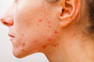 Hormonal Acne 2